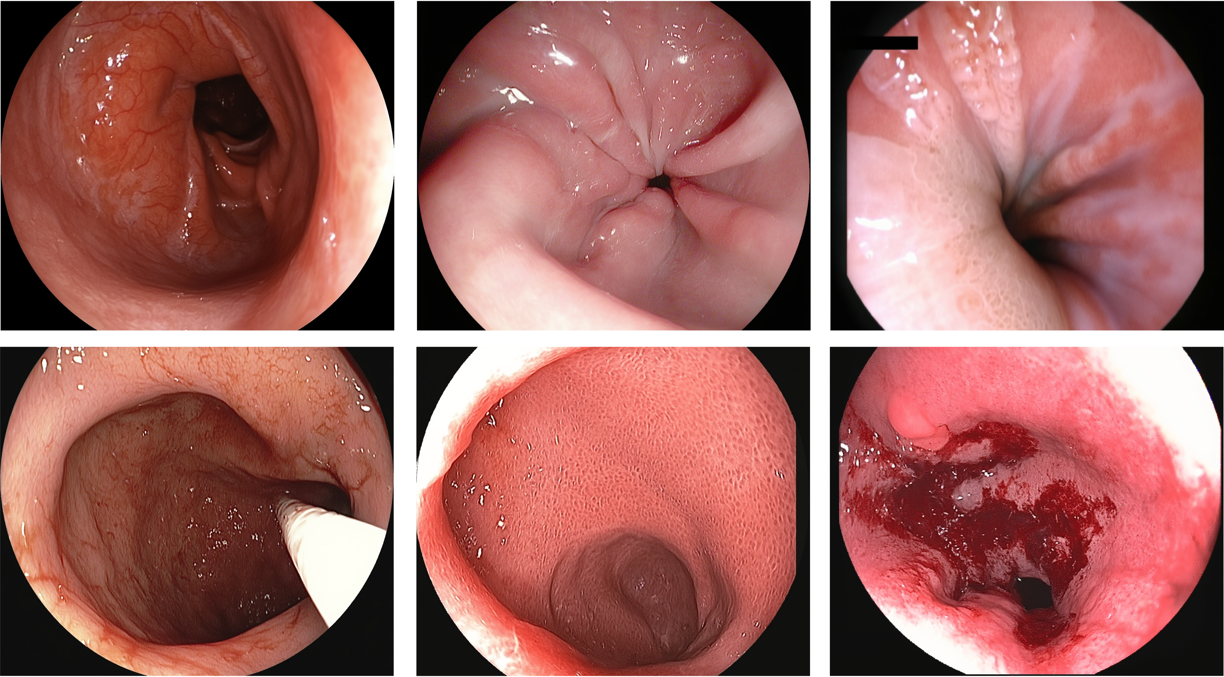 Endoscopy